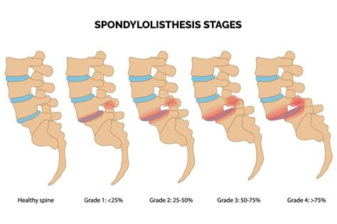 anterolistesi lv si|different grades of anterolisthesis.